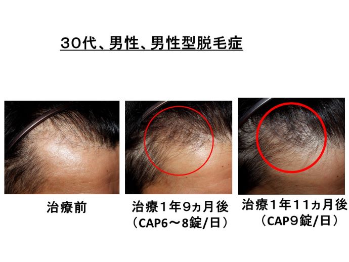 円形脱毛症　病院